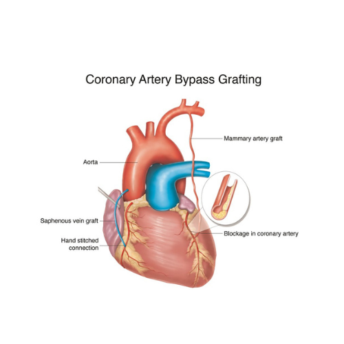 Coronary Artery Bypass Grafting (CABG)