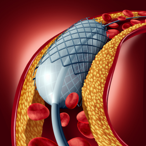 Angioplasty and Stent Placement