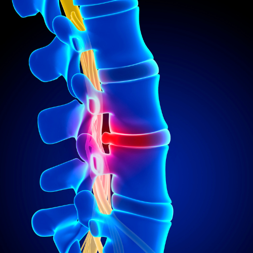 Herniated Disc Surgery (Discectomy)