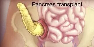 Pancreas-transplant-e1736149815951
